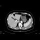 Splenic rupture: CT - Computed tomography